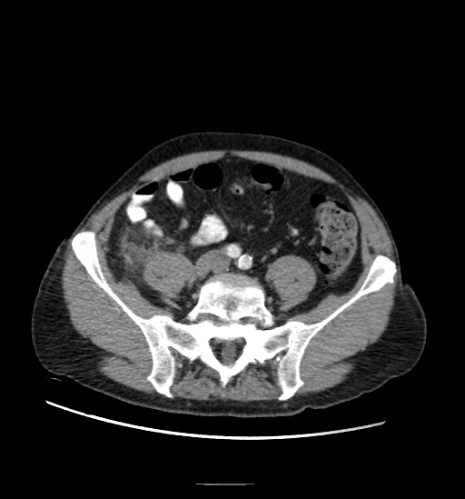 Appendicitis with localized perforation and abscess formation (Radiopaedia 49035-54130 A 63).jpg
