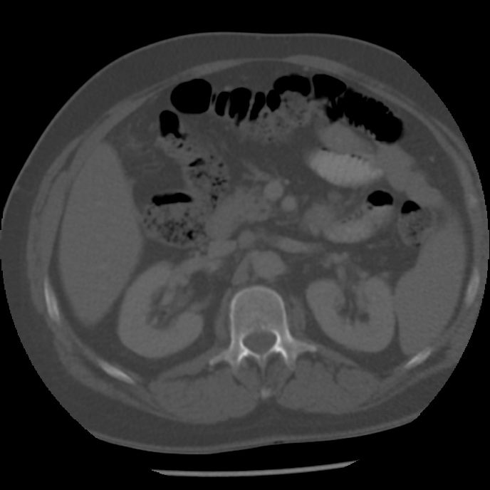 Appendicitis with perforation (Radiopaedia 35790-37342 Axial bone window 19).jpg