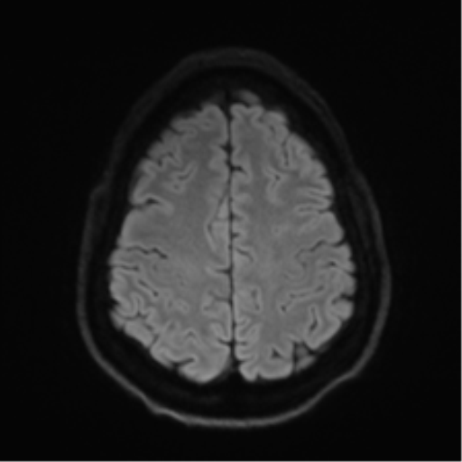 Arachnoid cyst - cerebellopontine angle (Radiopaedia 59689-67083 Axial DWI 64).png