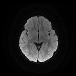 Arachnoid cyst - middle cranial fossa (Radiopaedia 86780-102938 Axial DWI 16).jpg