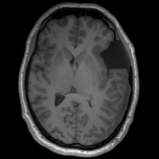 File:Arachnoid cyst with subdural hematoma (Radiopaedia 85892-101743 Axial T1 47).png