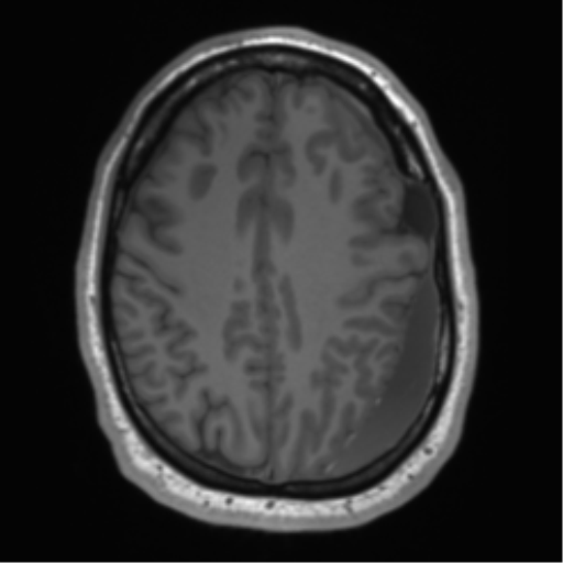 File:Arachnoid cyst with subdural hematoma (Radiopaedia 85892-101743 Axial T1 62).png