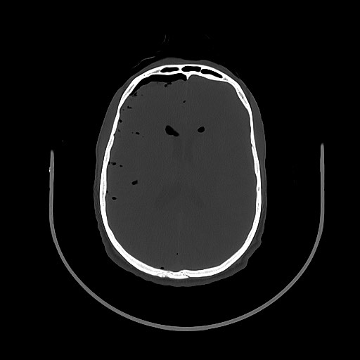 Arrow injury to the brain (Radiopaedia 72101-82607 Axial bone window 75).jpg