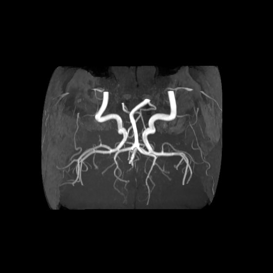 File:Artery of Percheron infarct (Radiopaedia 40966-43676 F 54).jpg