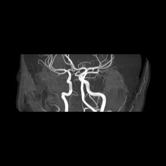File:Artery of Percheron infarct (Radiopaedia 40966-43676 G 39).jpg