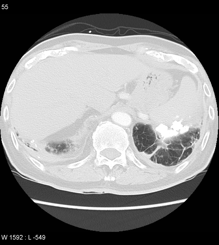 Asbestos related lung and pleural disease (Radiopaedia 14377-14301 A 52).jpg