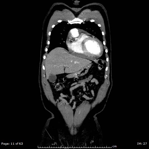 Ascending aortic aneurysm (Radiopaedia 50086-55404 B 11).jpg