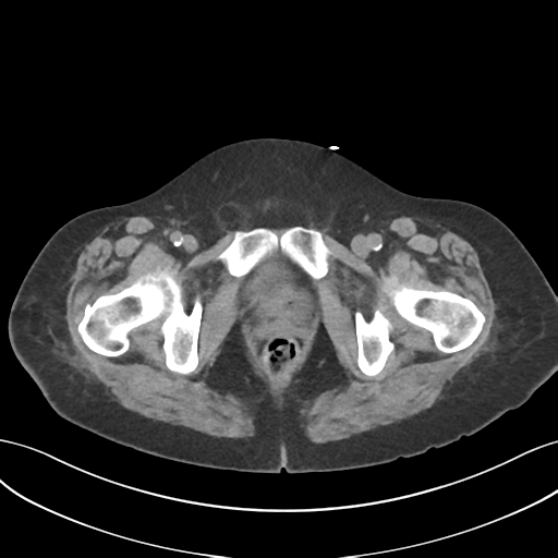 File:Ascending cholangitis (Radiopaedia 39068-41253 Axial non-contrast 68).png