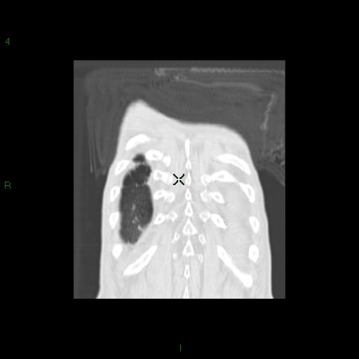File:Aspergilloma (Radiopaedia 14842-14787 Coronal lung window 35).jpg