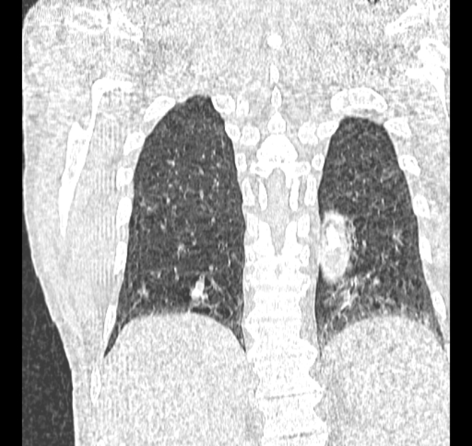 Aspergilloma (Radiopaedia 44592-48327 Coronal lung window 105).jpg