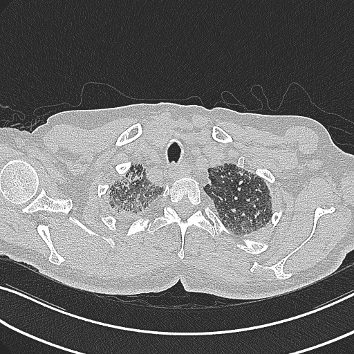 File:Aspergilloma on background pulmonary fibrosis (Radiopaedia 60942-68757 B 9).jpg
