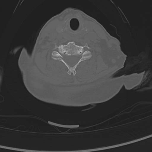 Atlanto-axial subluxation (Radiopaedia 36610-38176 Sagittal bone window 1).png