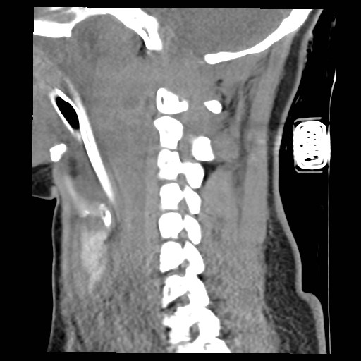 File:Atlanto-occipital dislocation (Radiopaedia 44648-48412 A 18).jpg