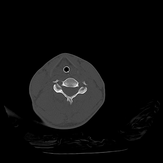 Atlanto-occipital dissociation (Traynelis type 1), C2 teardrop fracture, C6-7 facet joint dislocation (Radiopaedia 87655-104061 Axial bone window 61).jpg