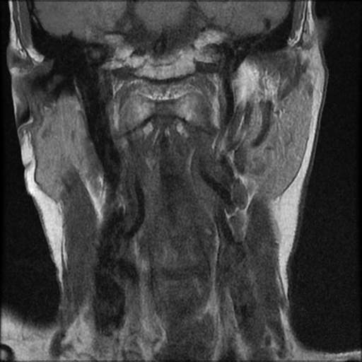 File:Atlantoaxial subluxation - rheumatoid arthritis (Radiopaedia 63564-72199 Coronal T1 6).jpg