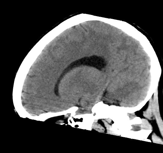 File:Atretic encephalocoele with inferior vermis hypoplasia (Radiopaedia 30443-31107 C 12).jpg