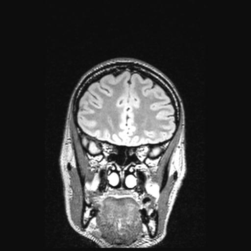 Atretic encephalocoele with inferior vermis hypoplasia (Radiopaedia 30443-31108 Coronal FLAIR 135).jpg