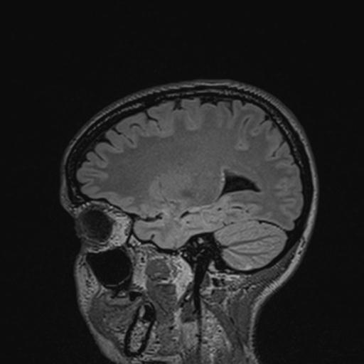 Atretic encephalocoele with inferior vermis hypoplasia (Radiopaedia 30443-31108 Sagittal FLAIR 56).jpg