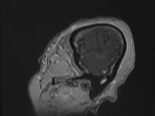 Atypical meningioma (Radiopaedia 62985-71406 Sagittal T1 C+ 2).jpg