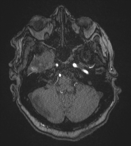 Atypical meningioma (WHO Grade II) (Radiopaedia 54742-60981 Axial MRA 22).png