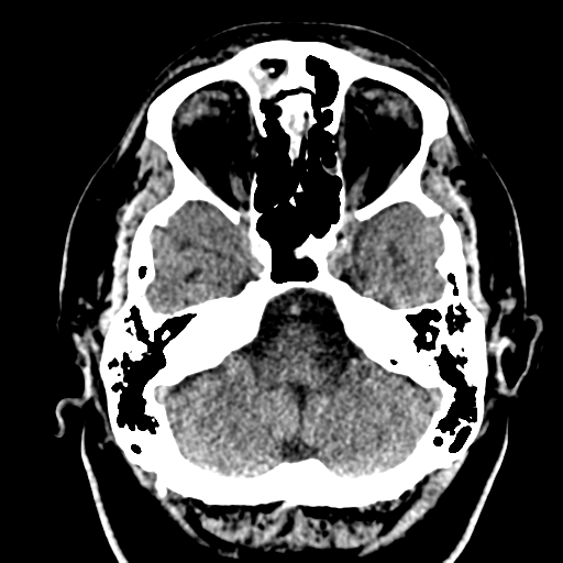 File:Atypical meningioma (WHO grade II) with brain invasion (Radiopaedia 57767-64728 Axial non-contrast 7).png
