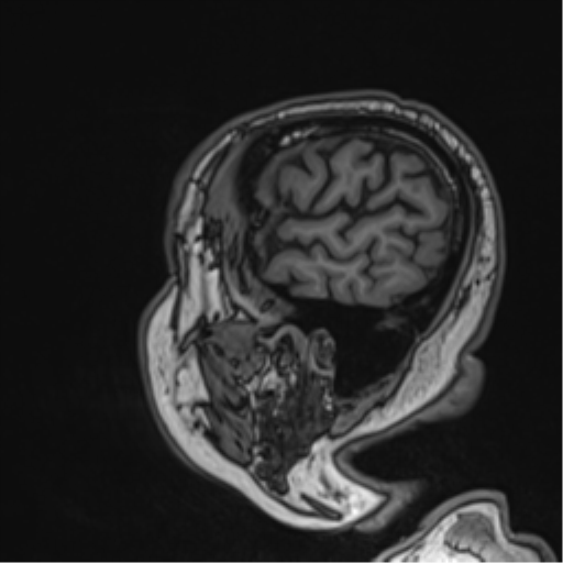 Atypical meningioma (WHO grade II) with brain invasion (Radiopaedia 57767-64729 Sagittal T1 16).png