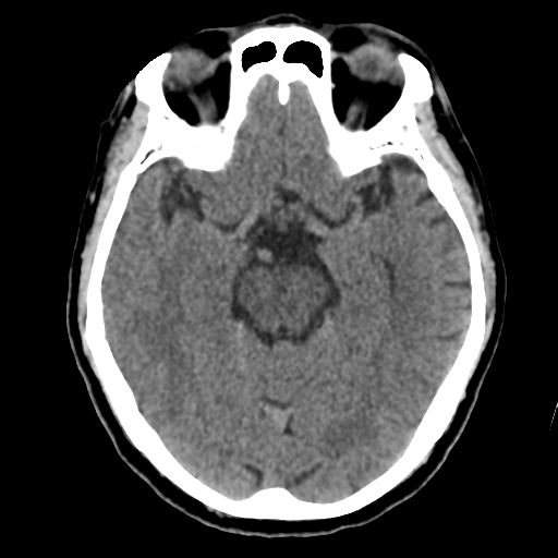 File:Atypical meningioma with skull invasion (Radiopaedia 34357-35649 Axial non-contrast 22).png