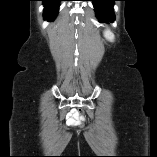 File:Atypical renal cyst (Radiopaedia 17536-17251 C 3).jpg