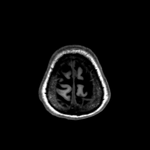 Autoimmune limbic encephalitis (Radiopaedia 30363-31005 T1 Axial 1mm 140).jpg