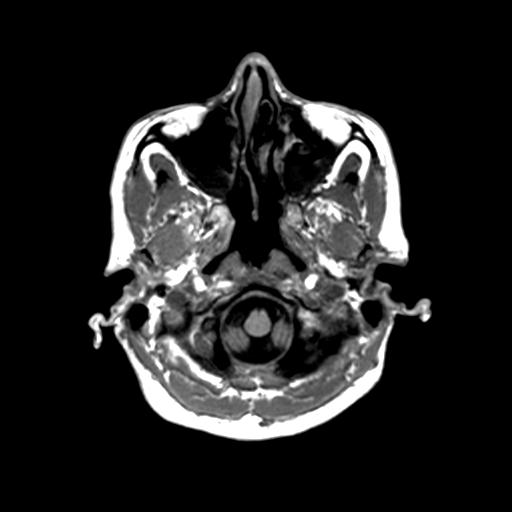 Autoimmune limbic encephalitis (Radiopaedia 30363-31005 T1 Axial 1mm 22).jpg