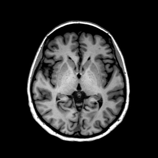 File:Autoimmune limbic encephalitis (Radiopaedia 30363-31005 T1 Axial 1mm 76).jpg