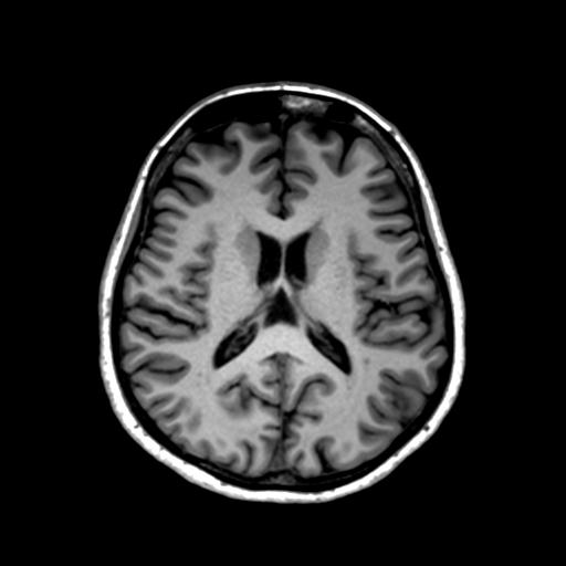 Autoimmune limbic encephalitis (Radiopaedia 30363-31005 T1 Axial 1mm 90).jpg