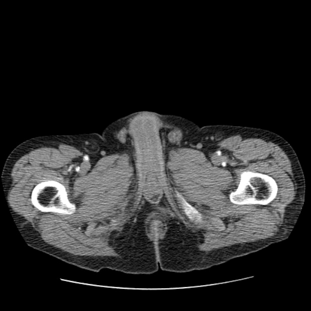 Autosomal dominant polycystic kidney disease (Radiopaedia 27851-28094 B 130).jpg