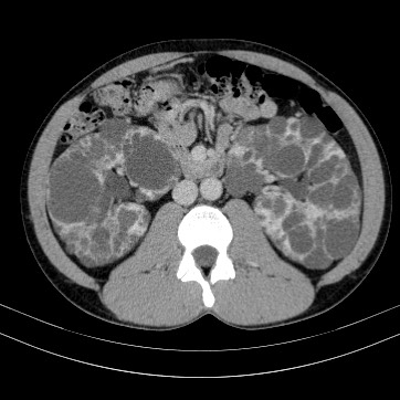 Autosomal dominant polycystic kidney disease (Radiopaedia 66349-75582 B 45).jpg