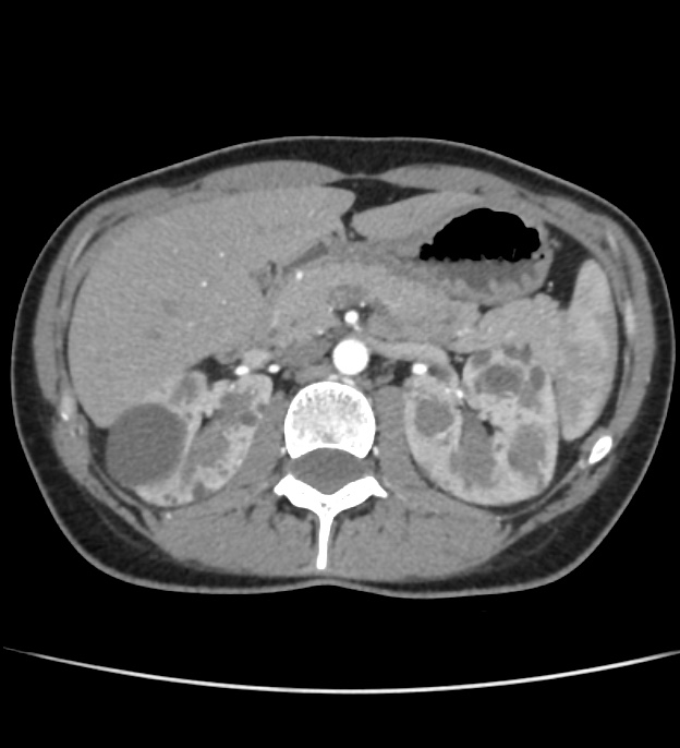 Autosomal dominant polycystic kidney disease - early onset (Radiopaedia 40734-43387 B 17).jpg