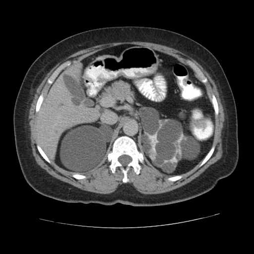 File:Autosomal dominant polycystic kidney disease with hepatic involvement (Radiopaedia 32693-33662 C 24).jpg