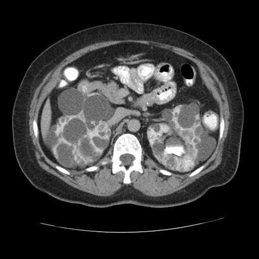 Autosomal dominant polycystic kidney disease with hepatic involvement (Radiopaedia 32693-33662 C 29).jpg
