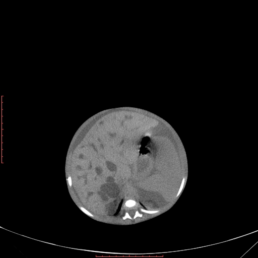 File:Autosomal recessive polycystic kidney disease associated with Caroli disease (Radiopaedia 61932-69984 Axial non-contrast 134).jpg