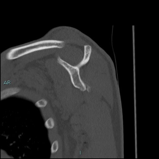 File:Avascular necrosis after fracture dislocations of the proximal humerus (Radiopaedia 88078-104653 Sagittal bone window 43).jpg