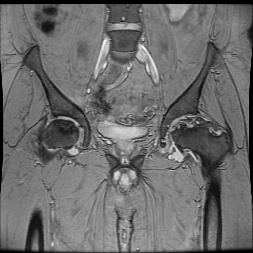 Avascular necrosis of the hip (Radiopaedia 61503-69465 F 38).jpg