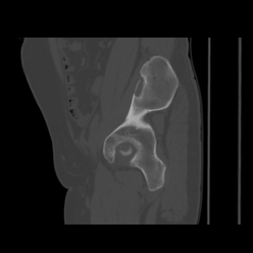 Avascular necrosis of the hip (Radiopaedia 61503-69467 B 19).jpg