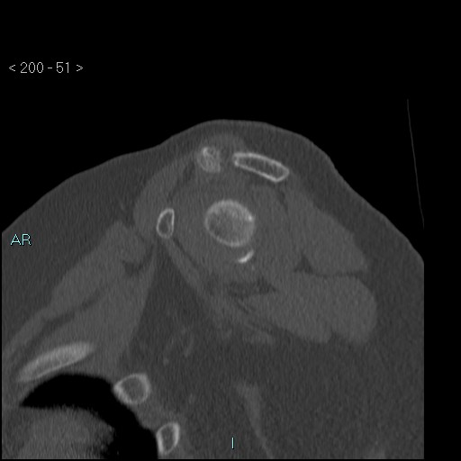 Avascular necrosis of the shoulder - Cruess stage I (Radiopaedia 77674-89887 Sagittal bone window 50).jpg