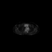 B-cell lymphoma of the mesentery (Radiopaedia 65743-74868 18F-FDG PET-CT 220).jpg