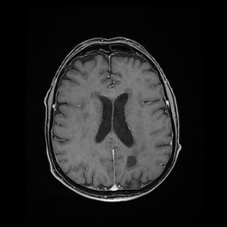 Balo concentric sclerosis (Radiopaedia 53875-59982 Axial LAVA C+ 163).jpg