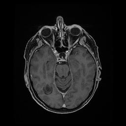 Balo concentric sclerosis (Radiopaedia 53875-59982 Axial LAVA C+ 99).jpg