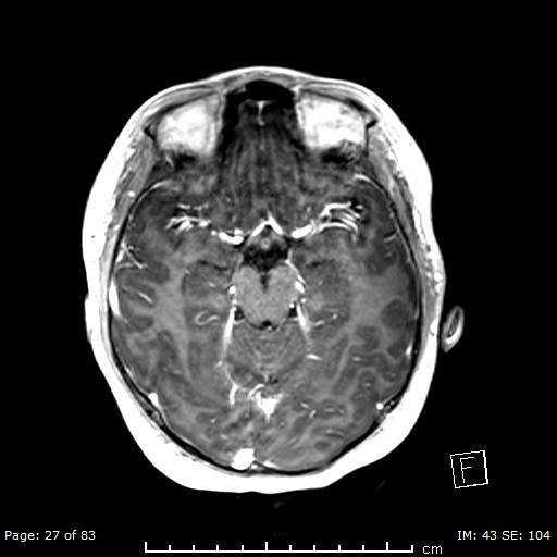 Balo concentric sclerosis (Radiopaedia 61637-69636 Axial T1 C+ 27).jpg