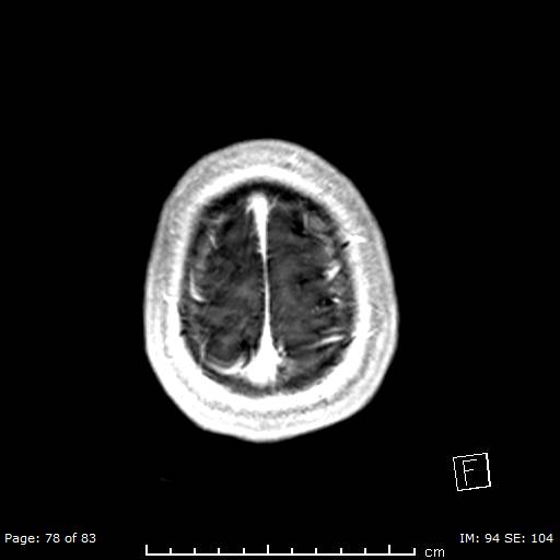 Balo concentric sclerosis (Radiopaedia 61637-69636 Axial T1 C+ 78).jpg
