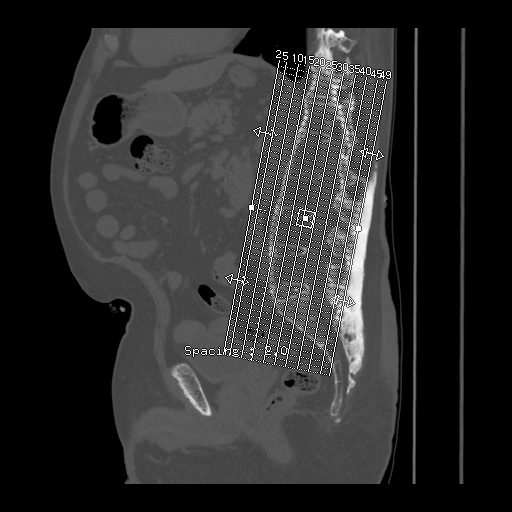 File:Bamboo spine (Radiopaedia 61848-69879 Coronal bone window 1).jpg