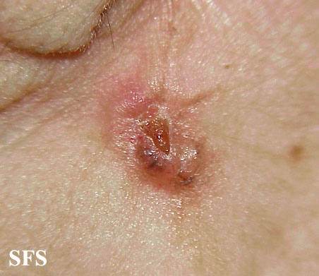 Basal Cell Carcinoma (Dermatology Atlas 147).jpg