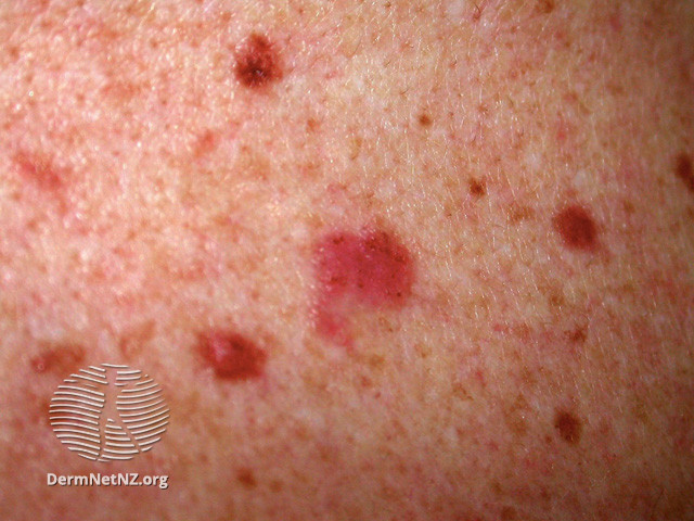 File:Basal cell carcinoma affecting the trunk (DermNet NZ lesions-bcc-trunk-1228).jpg